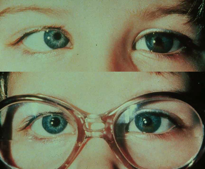 Очки для лечения косоглазия